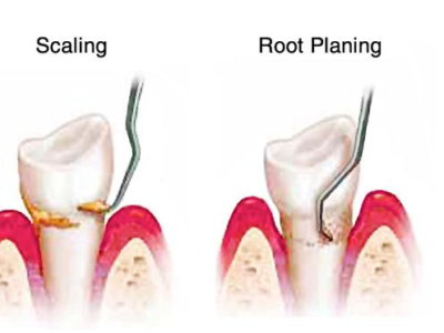 scaling and root planing pain