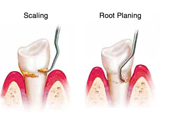 scaling and root planing pain