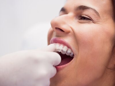 Invisalign Orthodontic Treatment